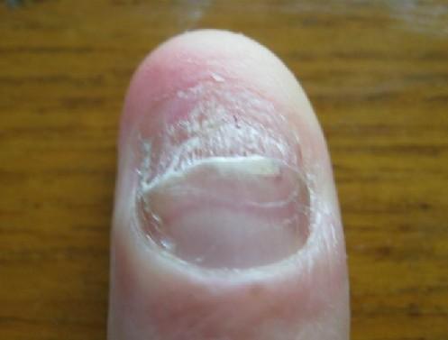 灰指甲治疗是需要把指甲整薄码?