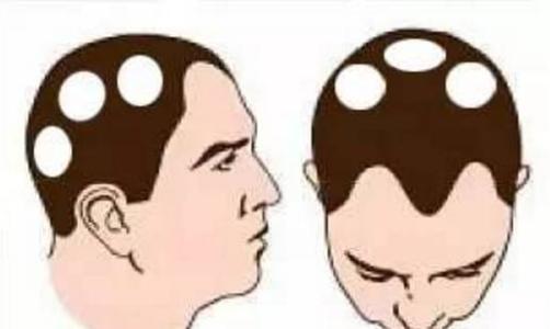 斑秃面积扩大都是什么原因呢?
