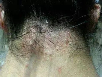 脂溢性皮炎会引起毛囊炎吗?