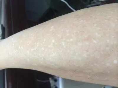 白癜风初期能够检查出来吗?
