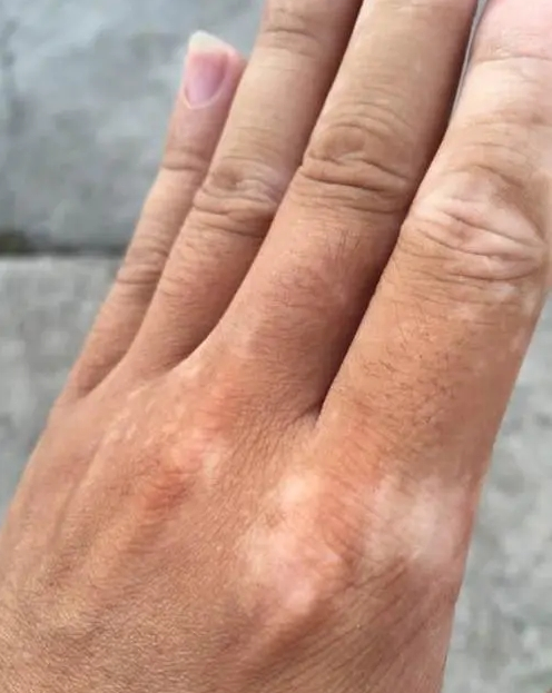 白癜风需要做什么检查才能确诊?