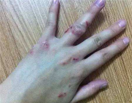 手癣临床上都有哪些类型呢?