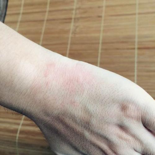 皮肤过敏应当如何检查过敏原因?