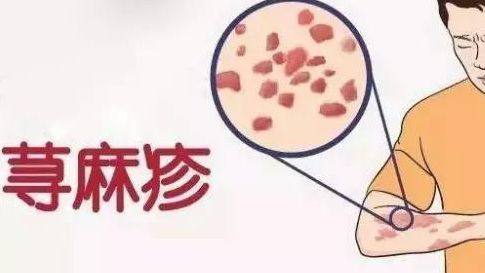 日光性荨麻疹是什么症状表现?