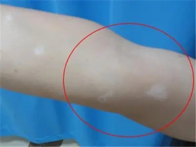 白癜风患者生活中要如何调理呢?