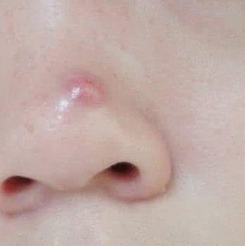 青春痘是不是结婚后就不长了呢?
