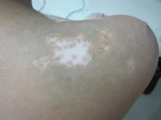白癜风和甲状腺有关联吗?