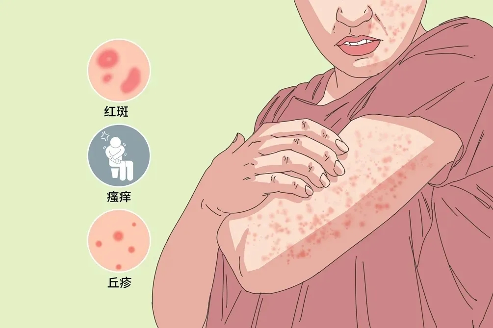 皮肤过敏会引起皮肤出现裂口吗?