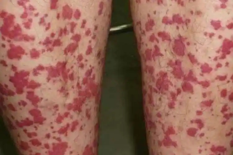 过敏性紫癜是不是好发于儿童?