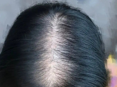 病理性斑秃是什么表现和原因?