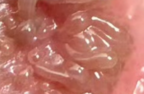 生殖疣的症状是软的还是硬的呢?