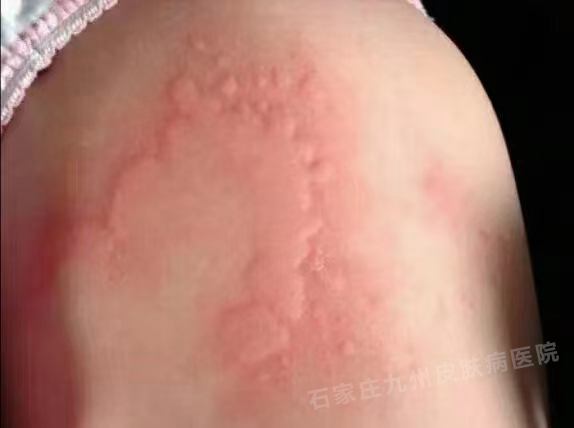荨麻疹颜色变深是病情严重了吗?
