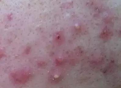 痤疮和细菌感染应当如何区分?