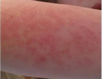 皮肤过敏患者能吃大蒜吗?