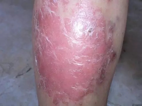 牛皮癣的三联征是怎么回事呢?