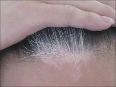 头部白癜风会引起掉头发吗?