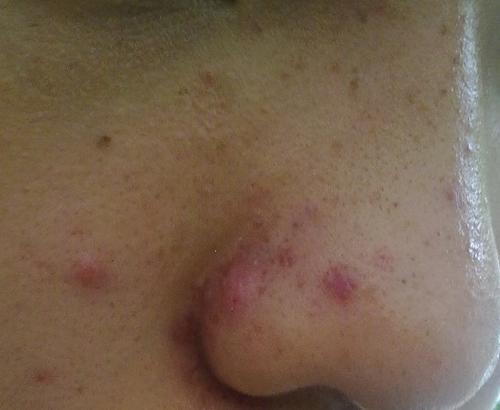青春痘是如何分辨轻重程度的?