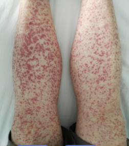 过敏性紫癜是可遗传的疾病吗?
