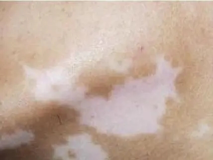白癜风会引起皮肤出现干燥吗?