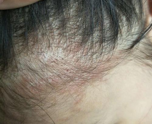 头部银屑病和脂溢性皮炎如何区分?