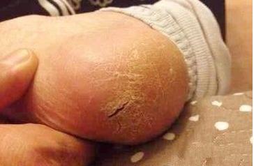 湿疹是红疹子还是红色斑块呢?