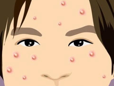 青春痘和痱子应当如何区分辨别?