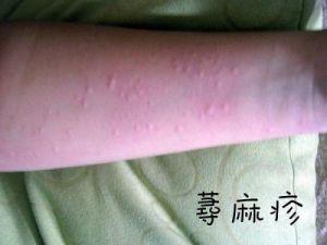 荨麻疹为什么会引起呼吸困难呢?