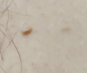 丝状疣会出现在任何部位上吗?