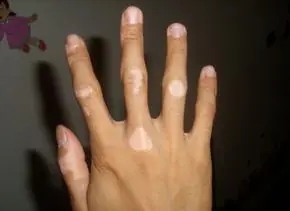 手部白癜风会扩散到身上吗?