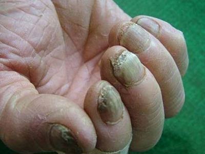 灰指甲是哪种真菌引起的疾病?